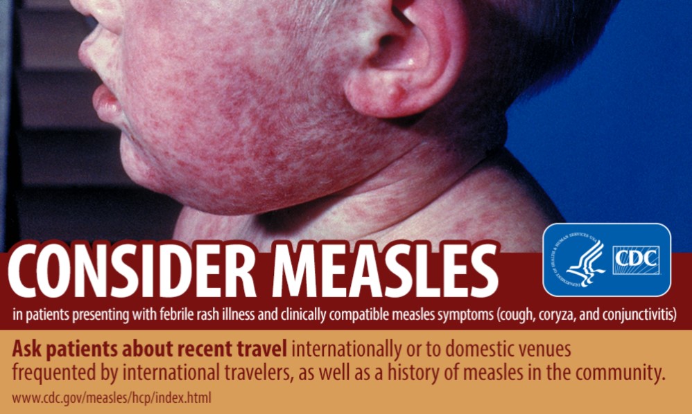 Measles Advisory Ocean County Health Department